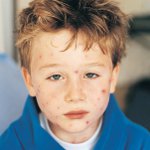 Molluscum contagiosum στα παιδιά