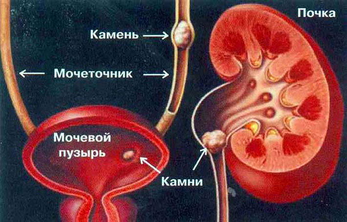 Λίθοι νεφρών: θεραπεία με λαϊκές θεραπείες