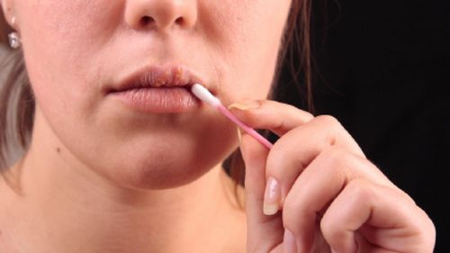 Αποτελεσματικοί τρόποι θεραπείας των κρυολογήματος στα χείλη